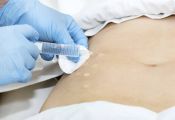 Mesoterapia Antalgica